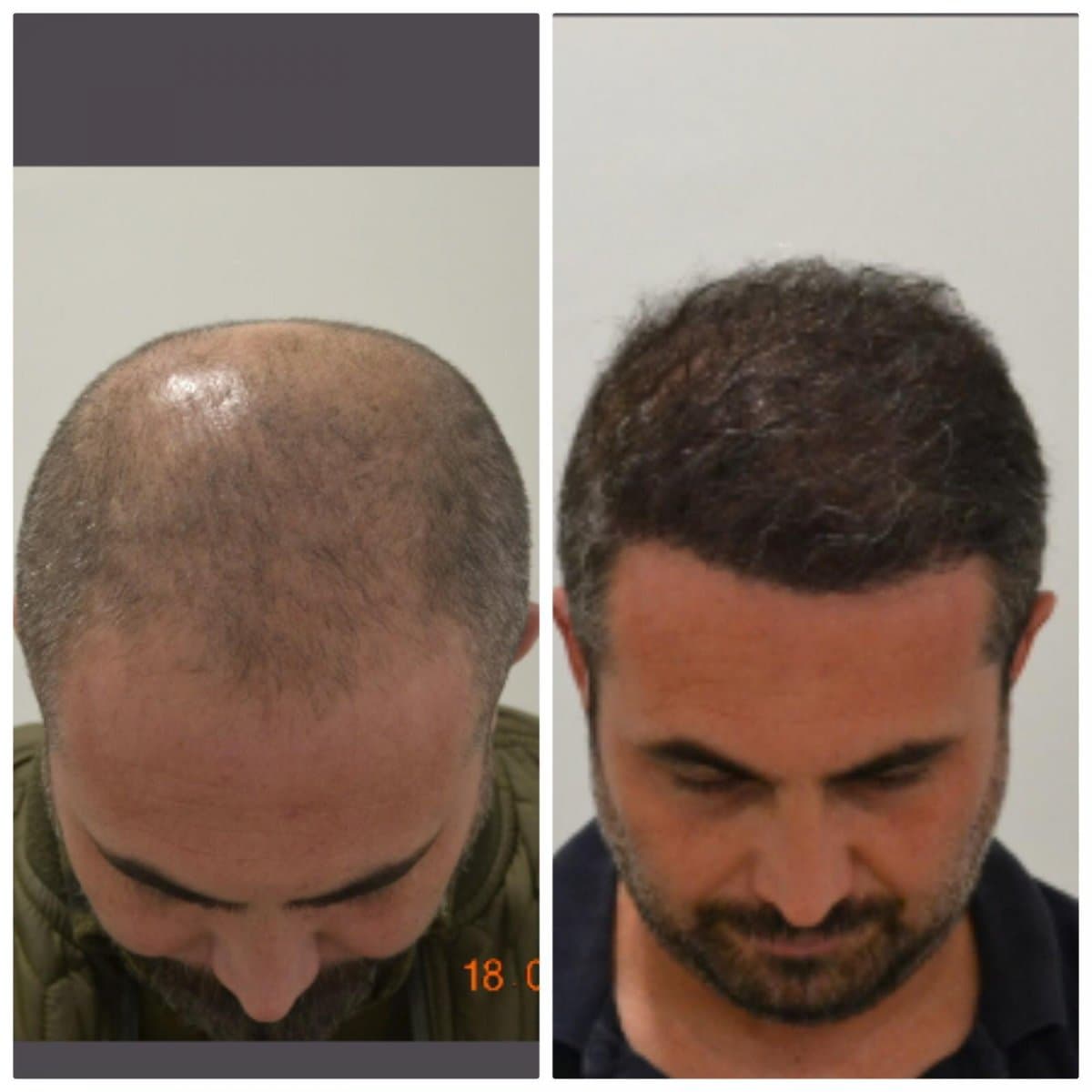 DHI hair transplant