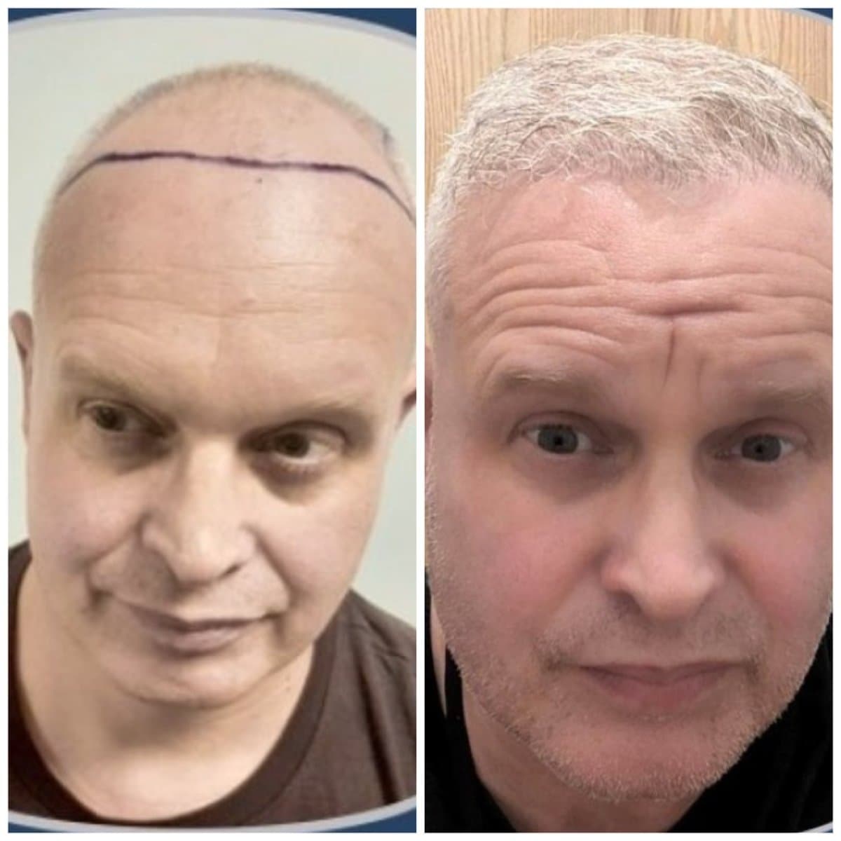 DHI hair transplant