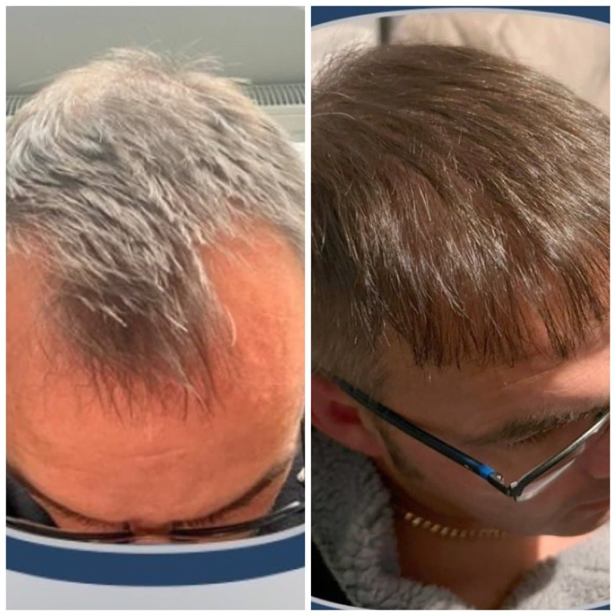 DHI hair transplant