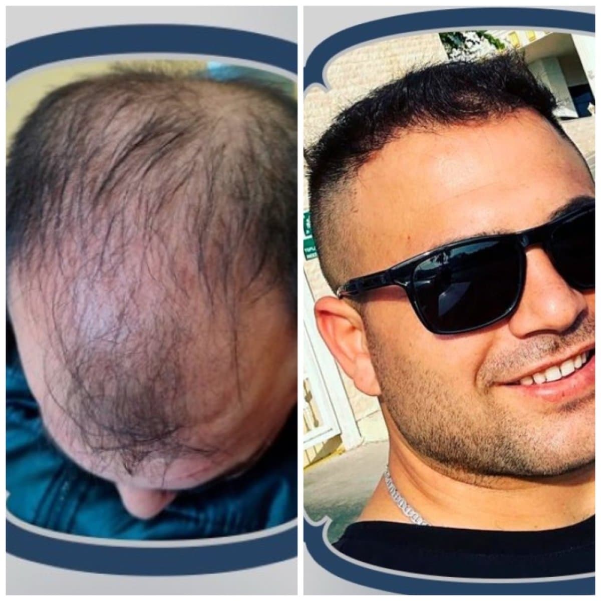 DHI hair transplant