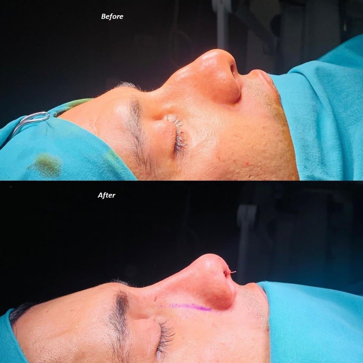 rhinoplasty