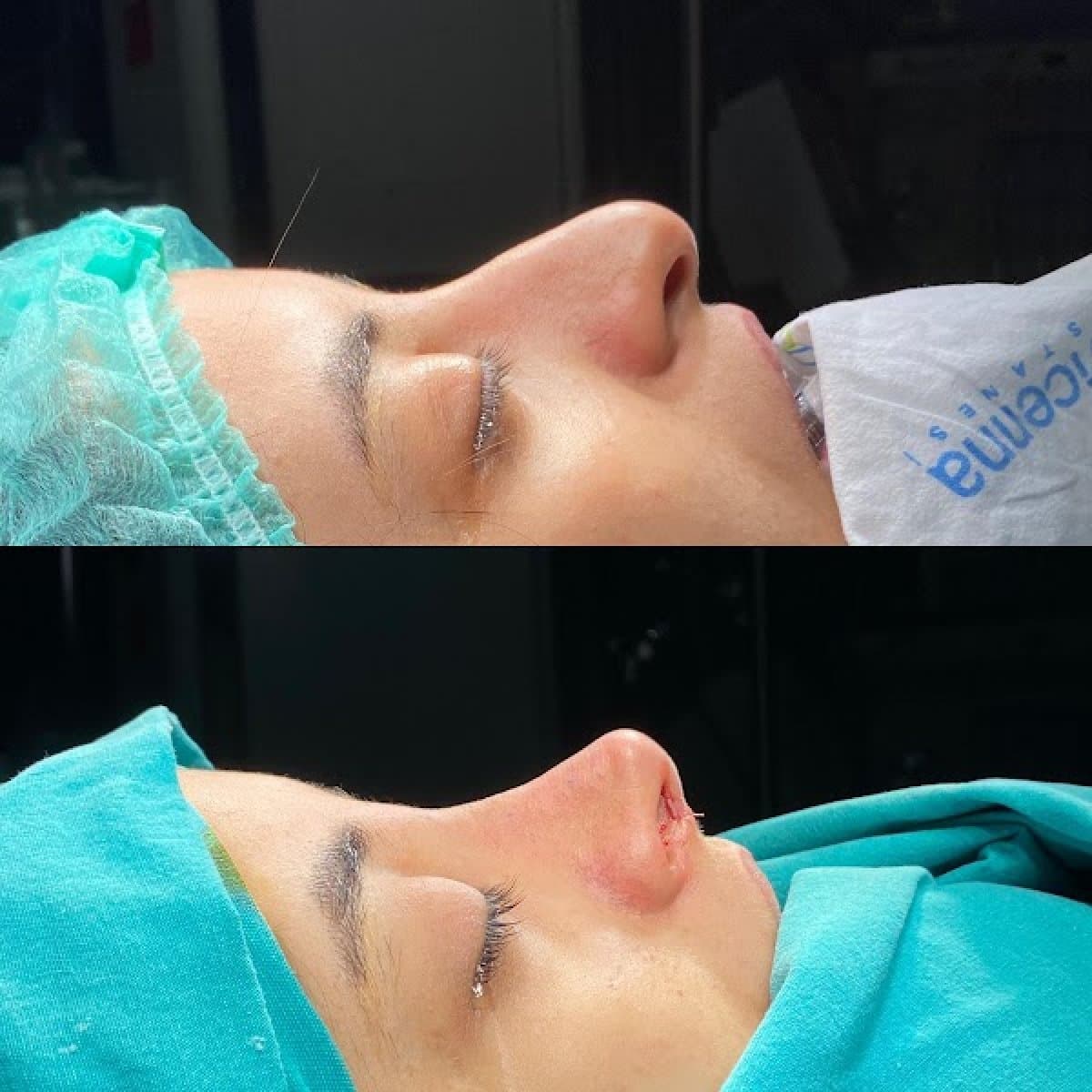 revision rhinoplasty