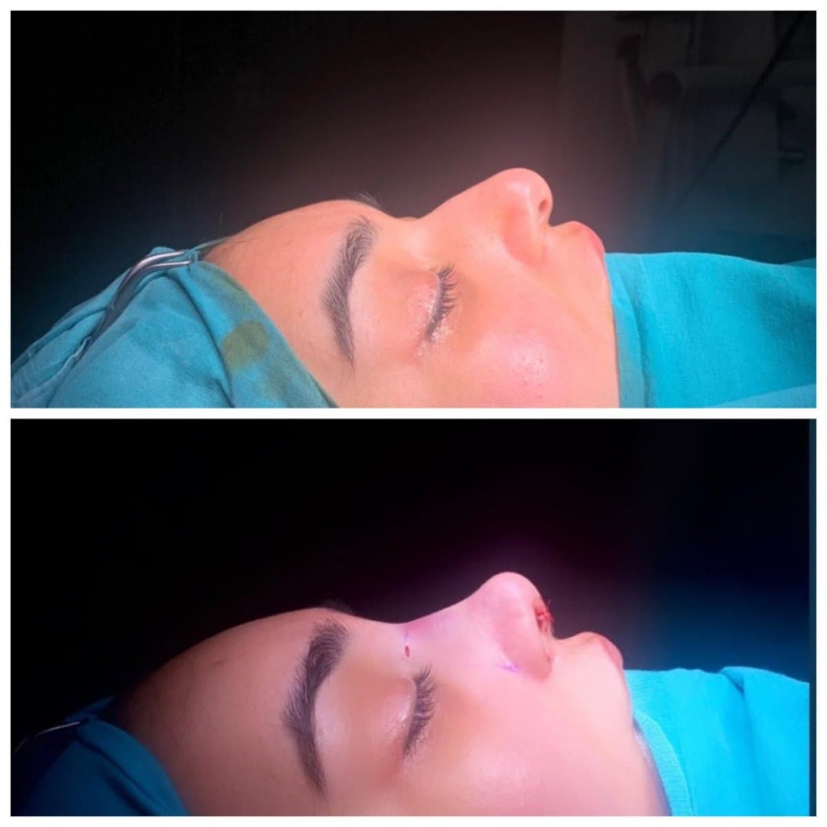 rhinoplasty