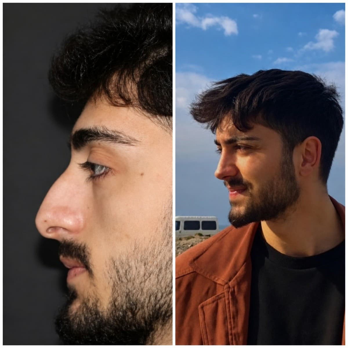 rhinoplasty