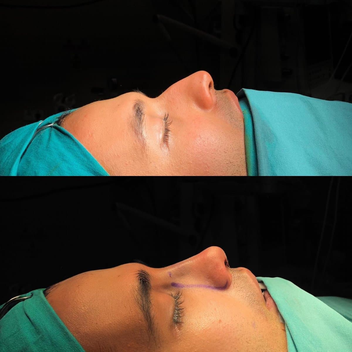 rhinoplasty
