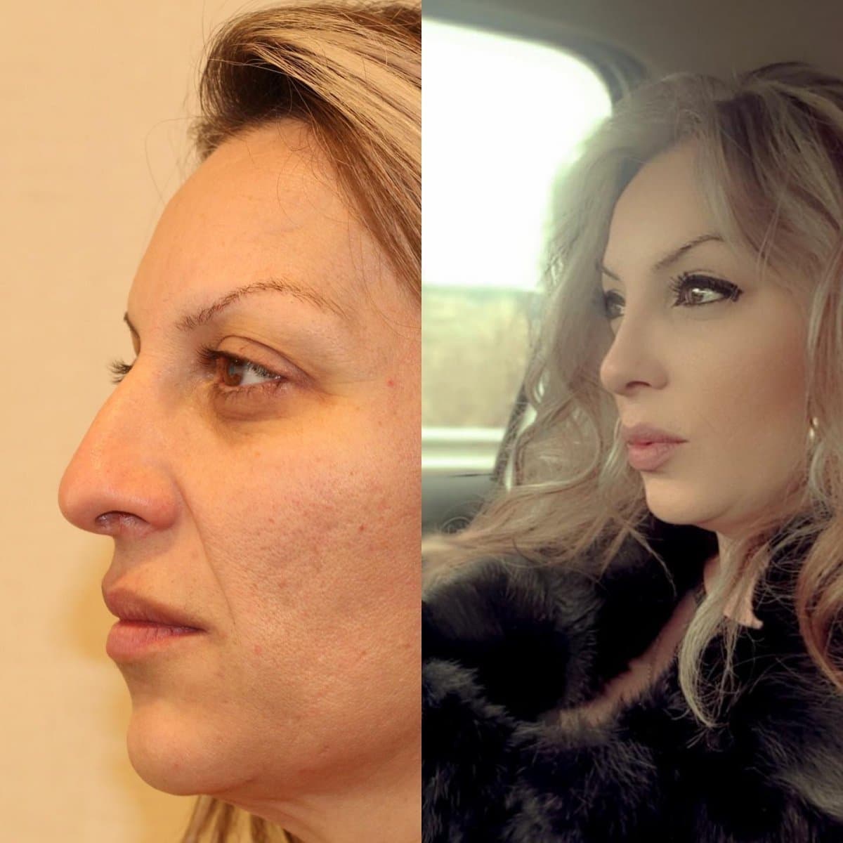 rhinoplasty