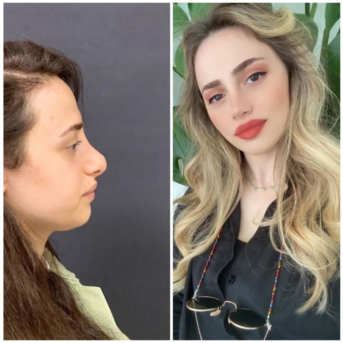 rhinoplasty