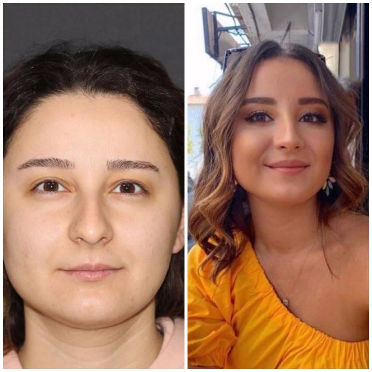 rhinoplasty