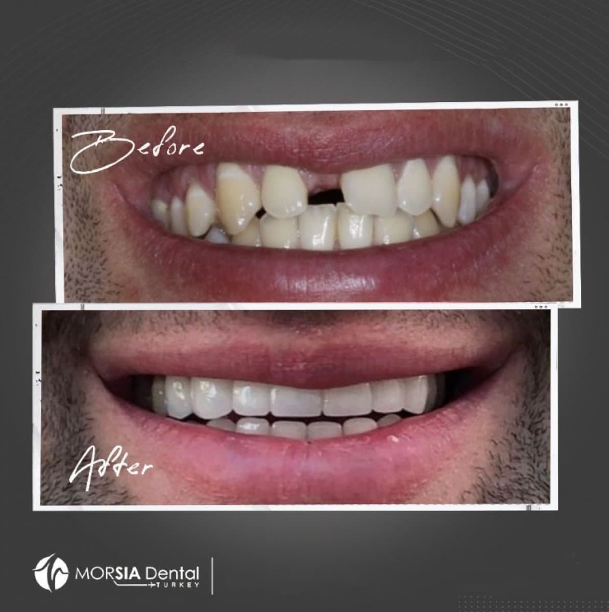 zirconia dental bridge
