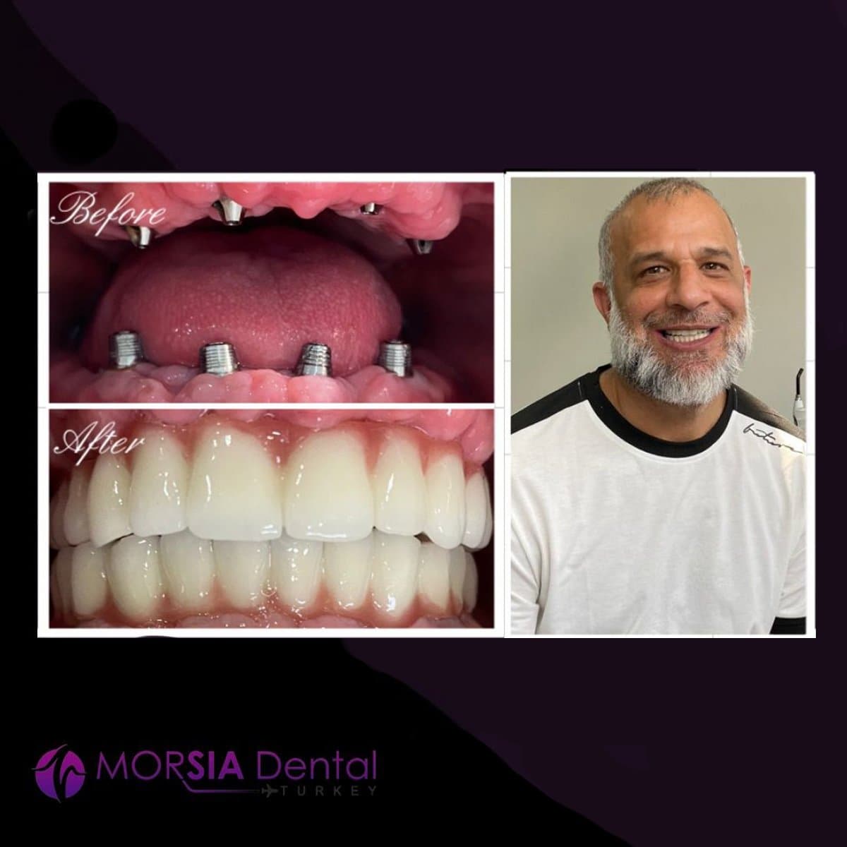 denture
