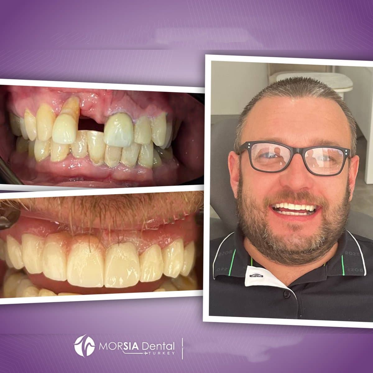 zirconia dental bridge