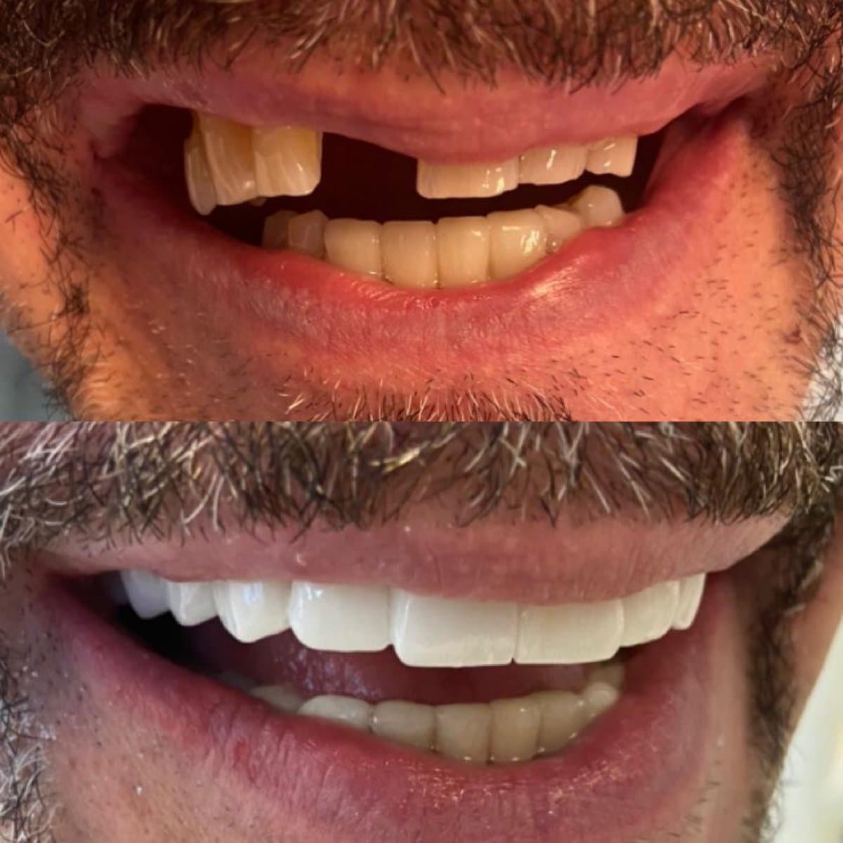 dental crown installation