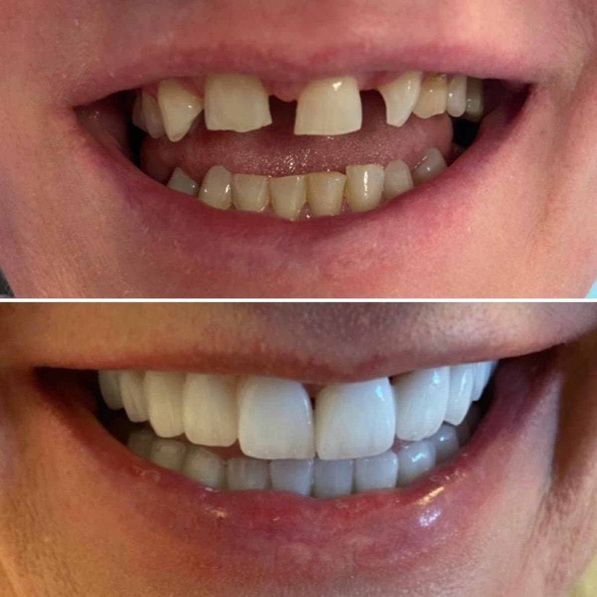 zirconia crown