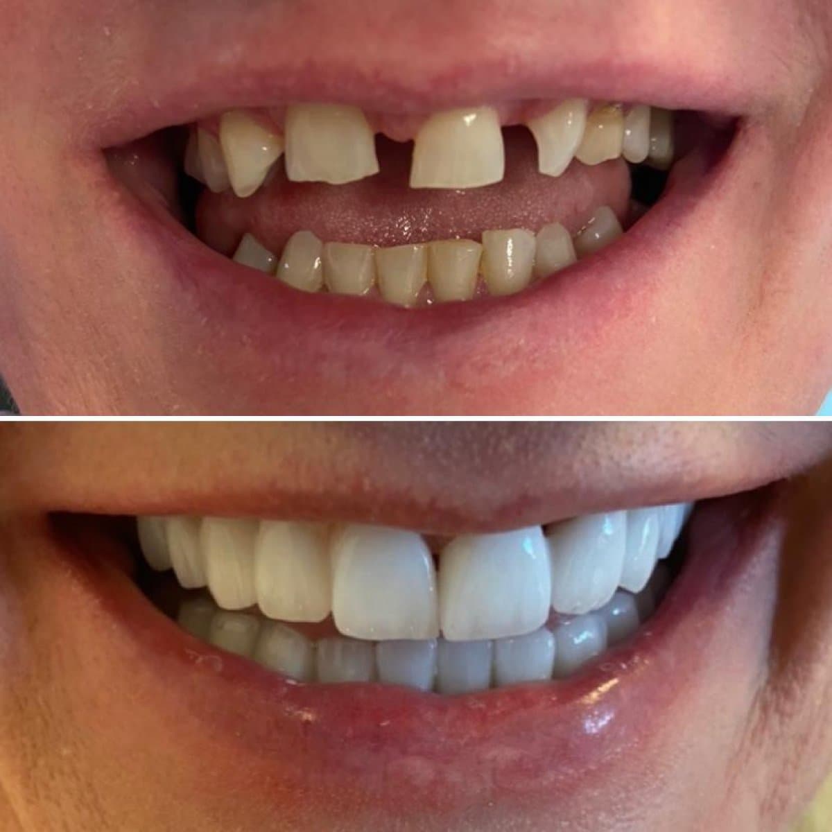 dental crown installation