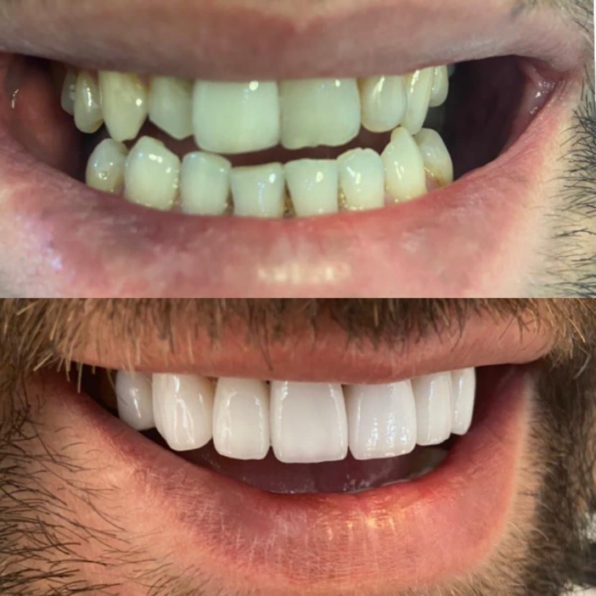 veneers
