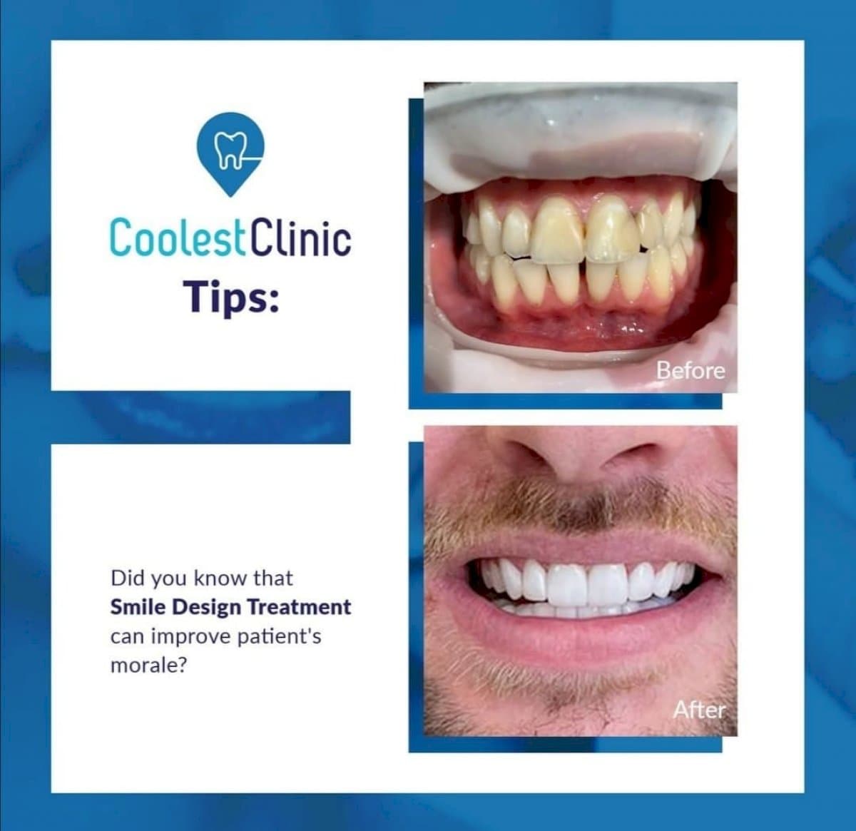 veneers