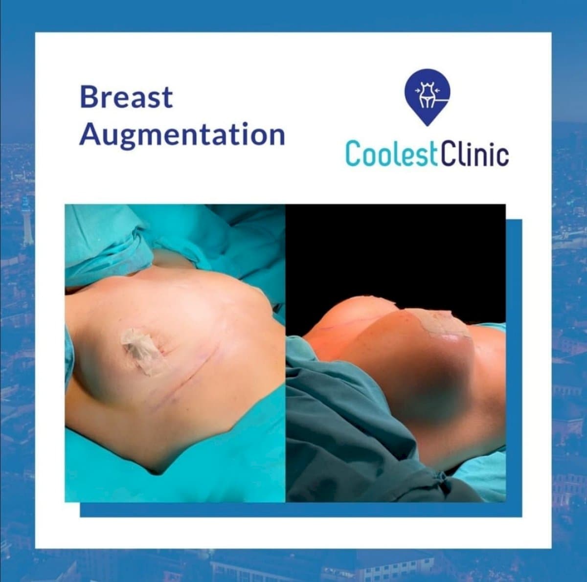 breast augmentation