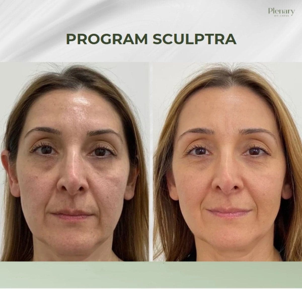 Sculptra facial rejuvenation