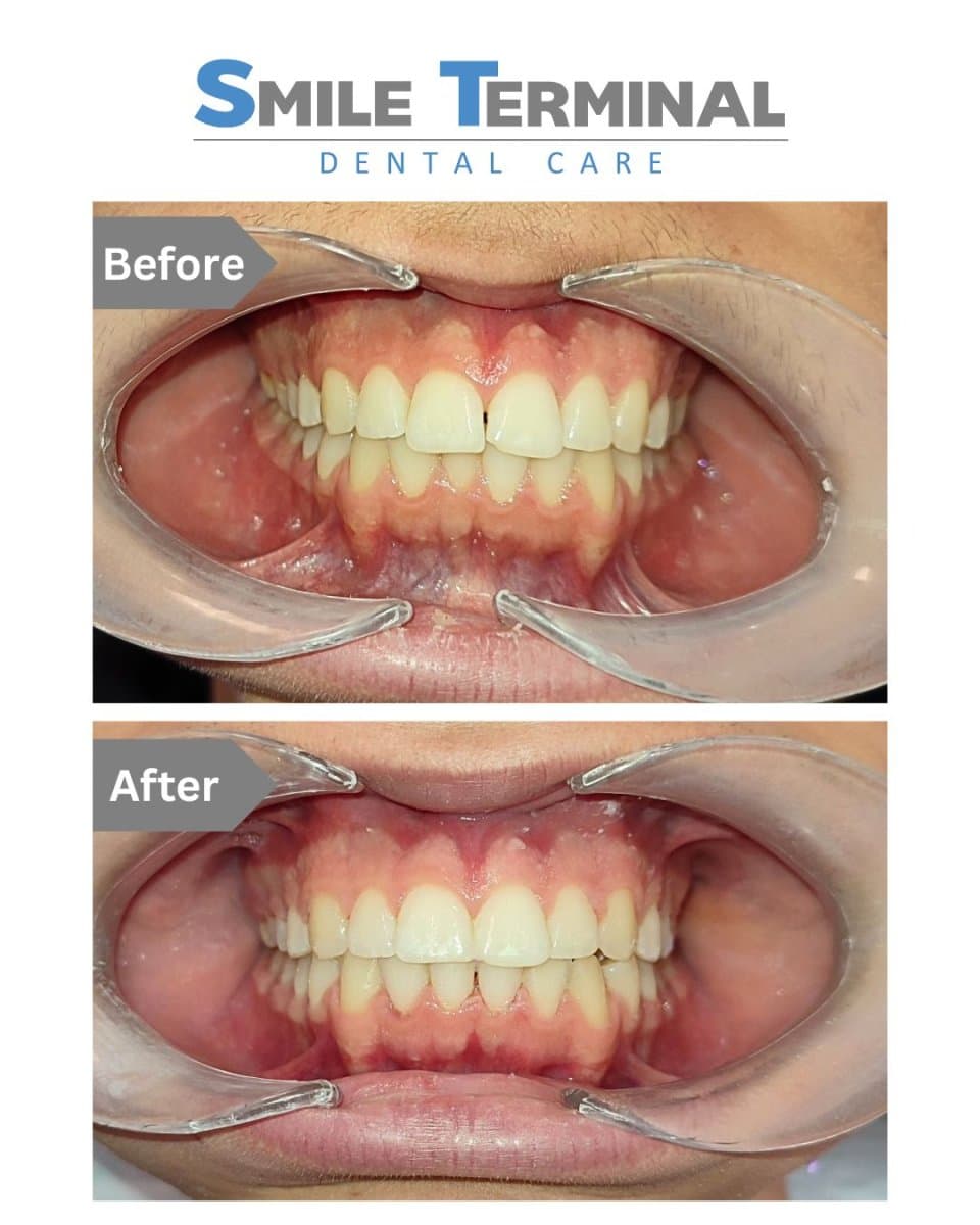 braces for kids