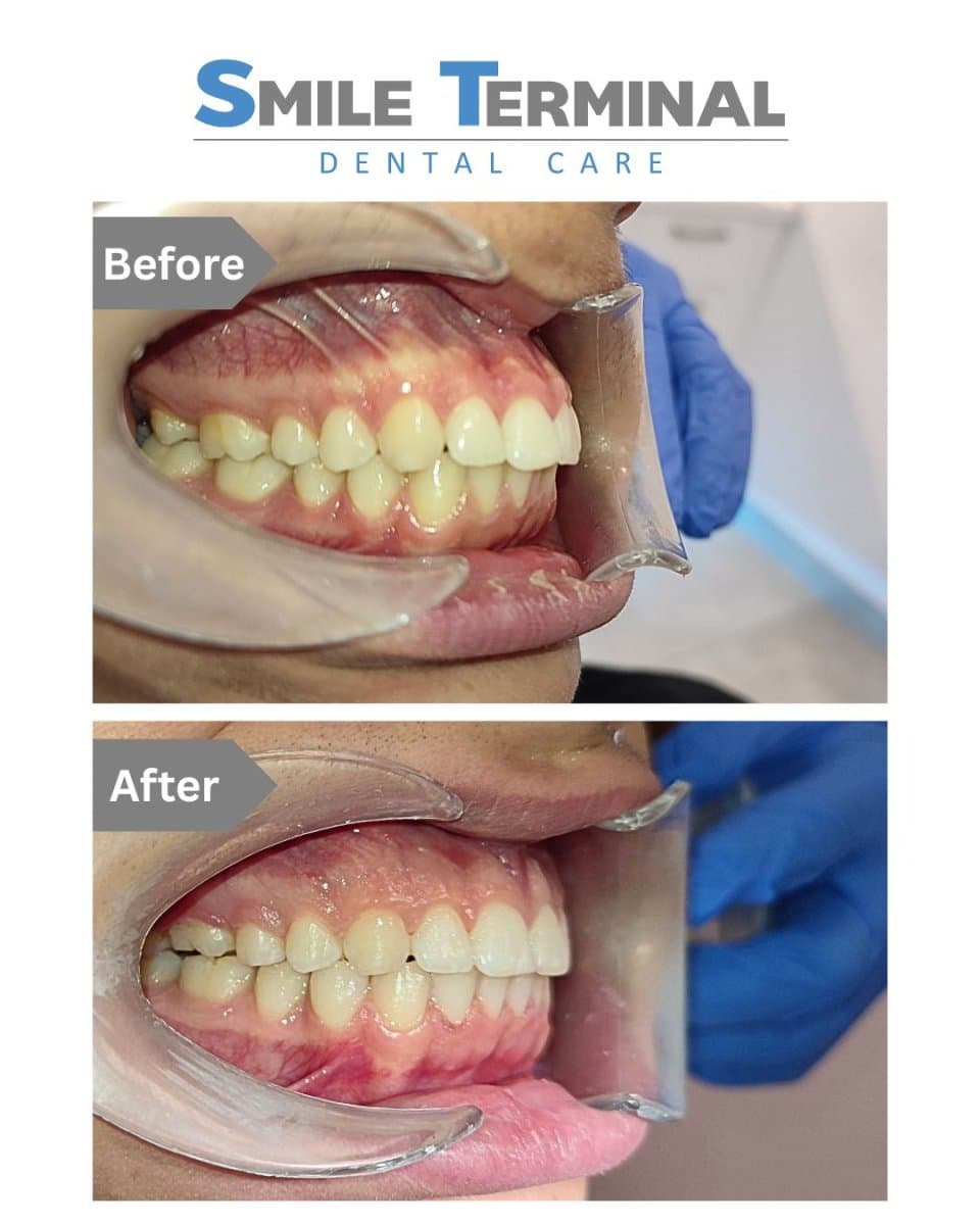 braces for kids