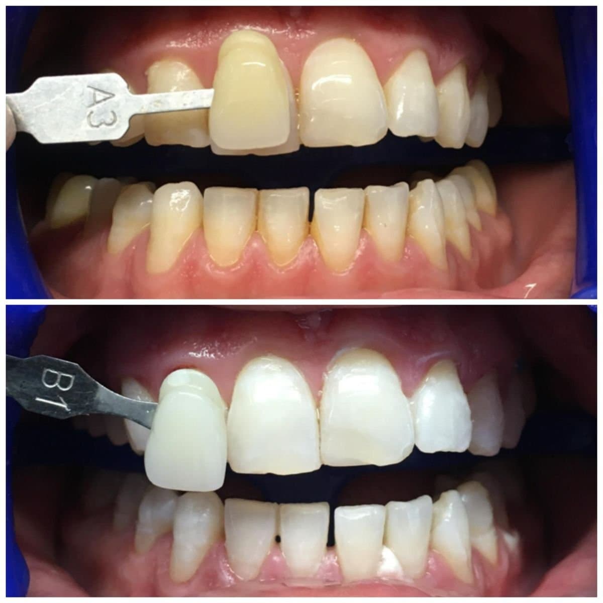 teeth cleaning