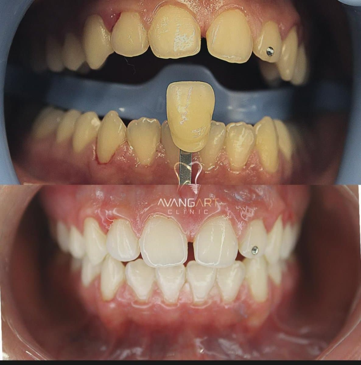 teeth cleaning (scaling)