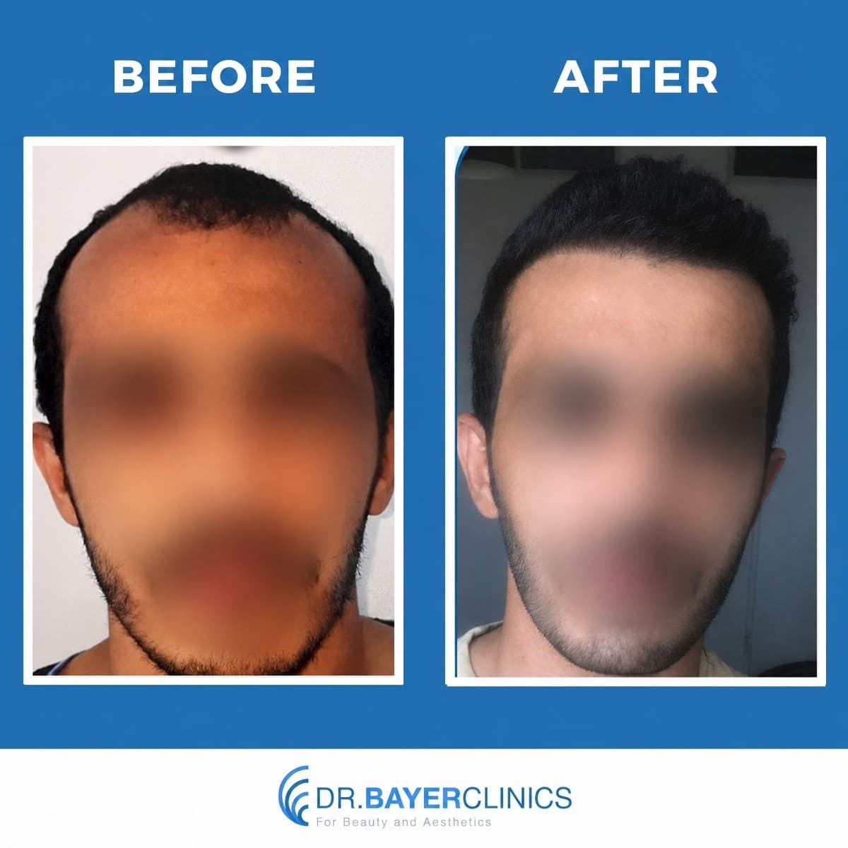 DHI hair transplant