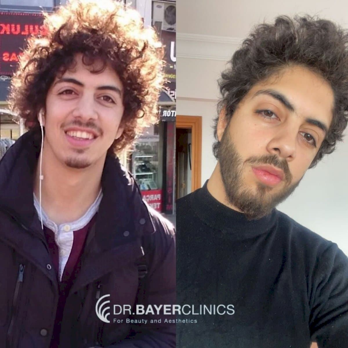 beard transplant