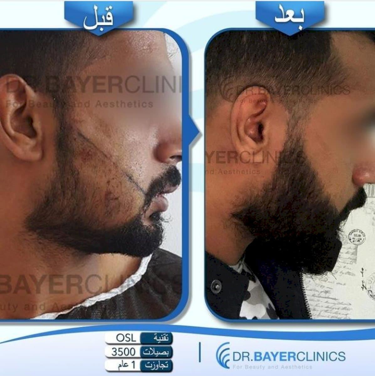 beard transplant