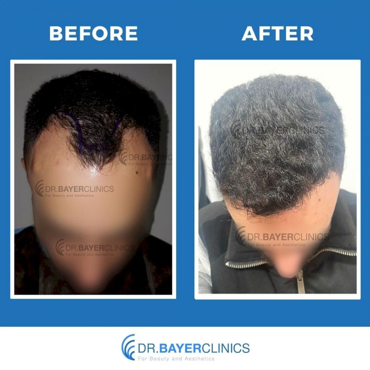 DHI hair transplant