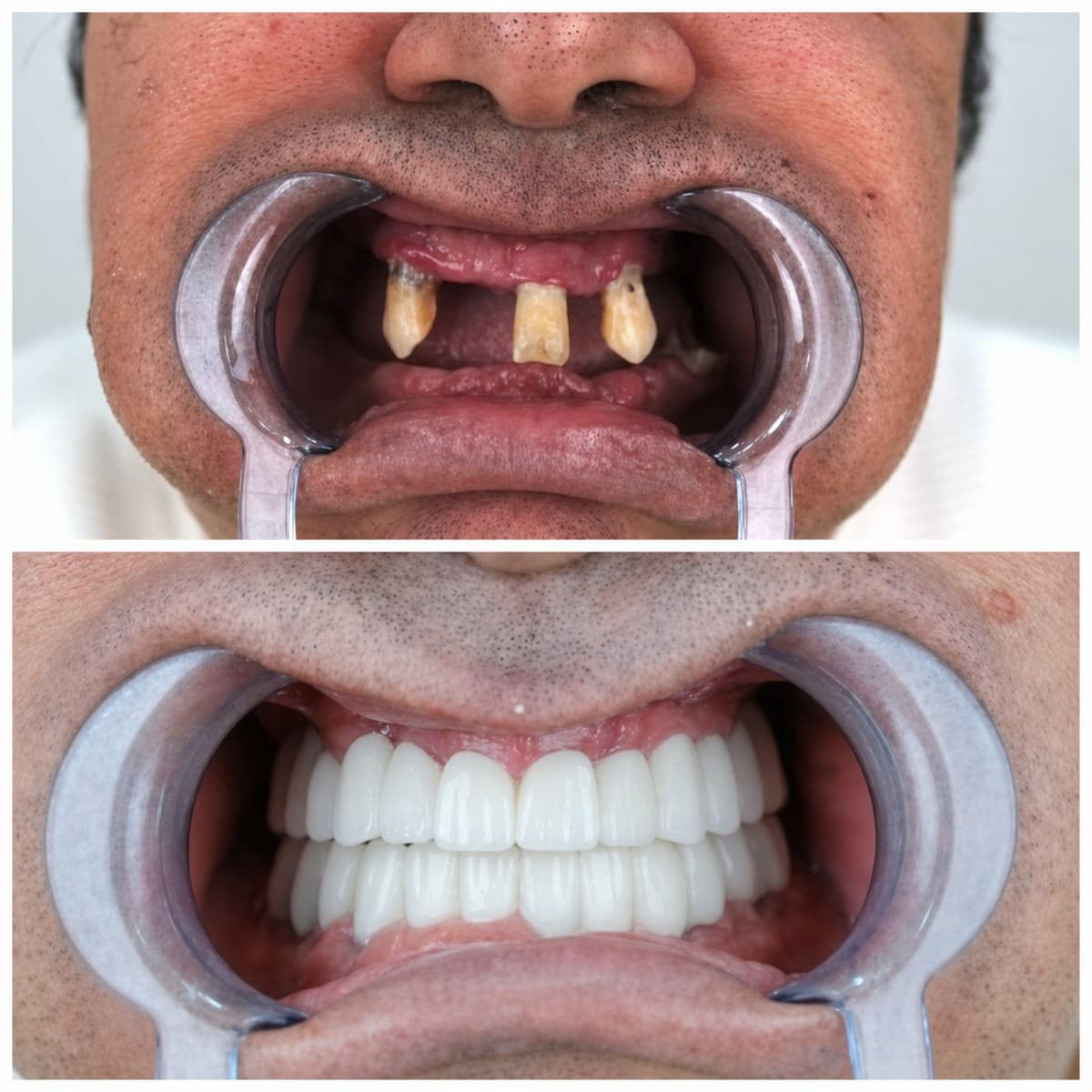 zirconia dental bridge