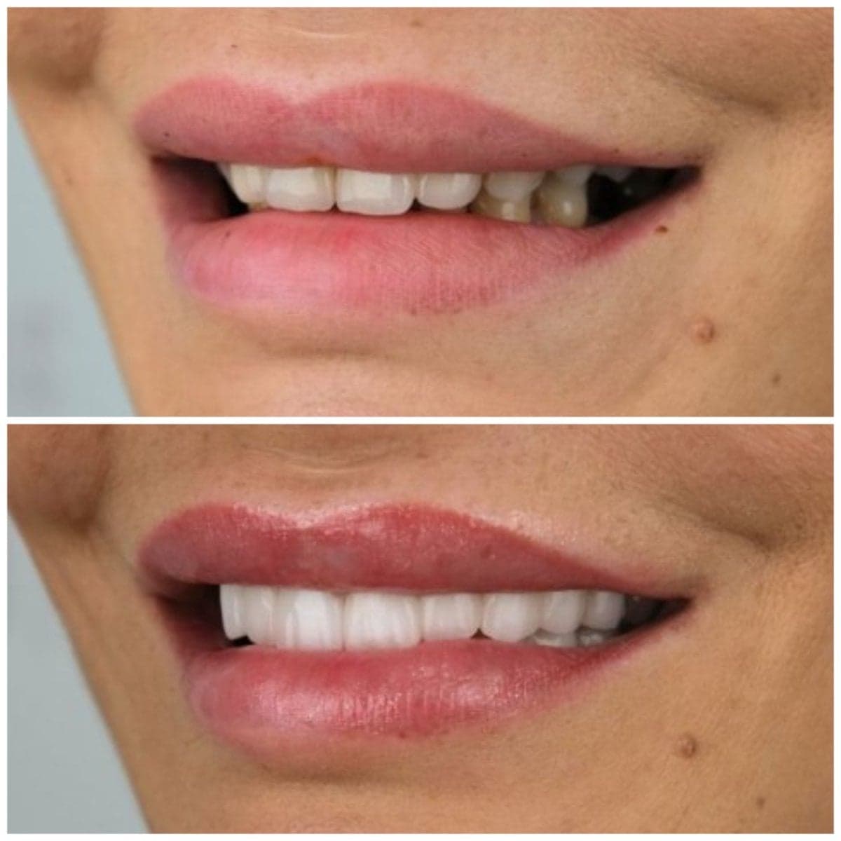 smile makeover