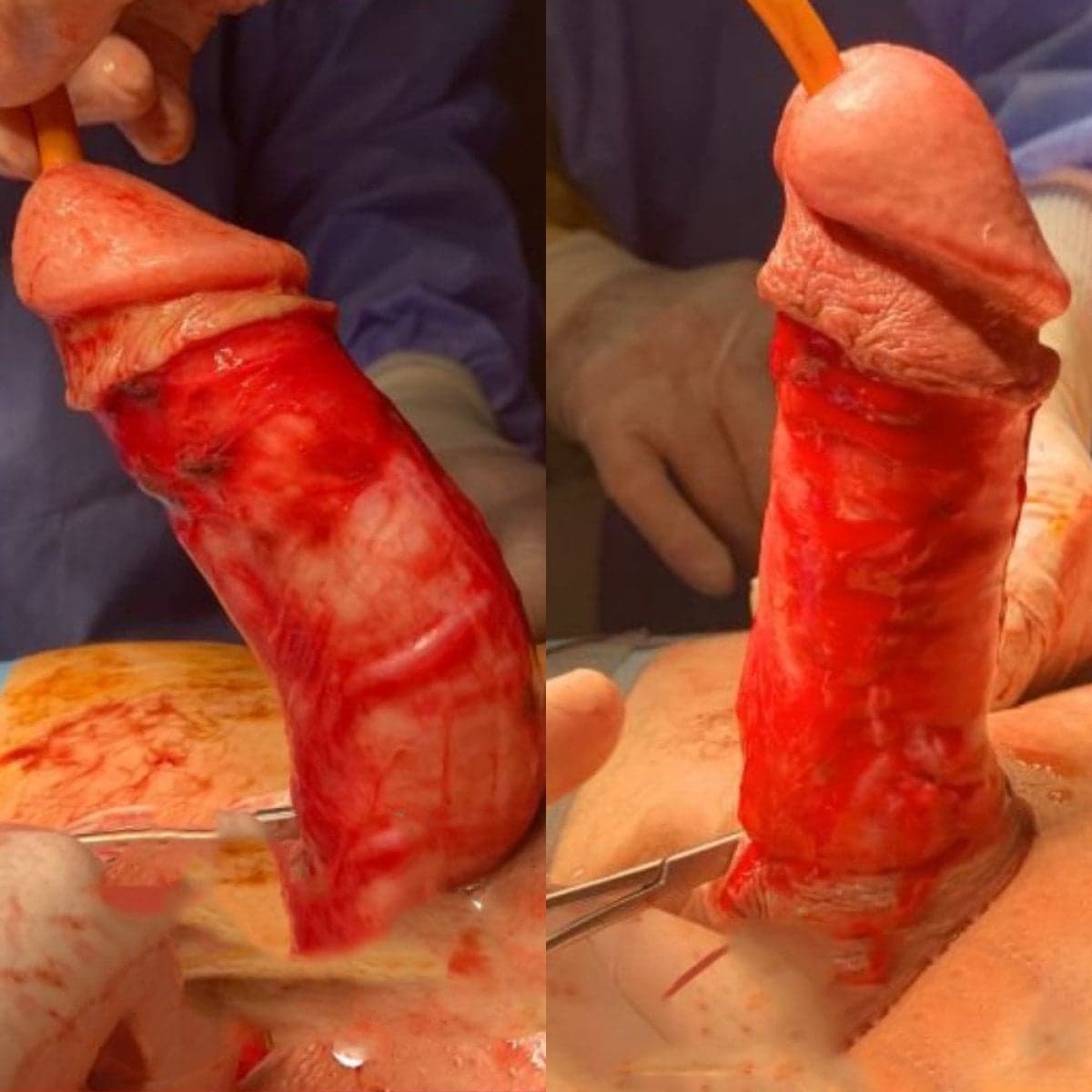 penile curvature correction surgery