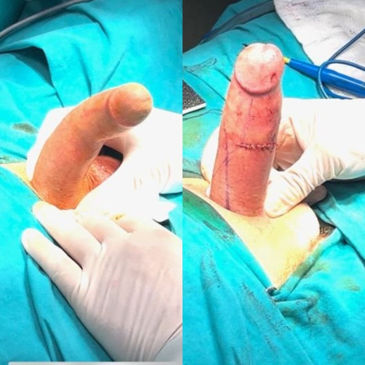 penile curvature correction