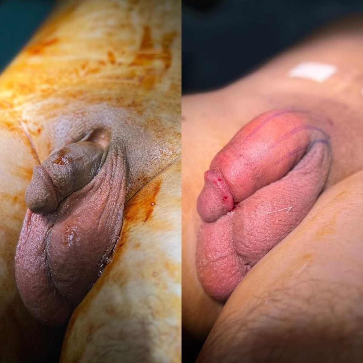 penis enlargement