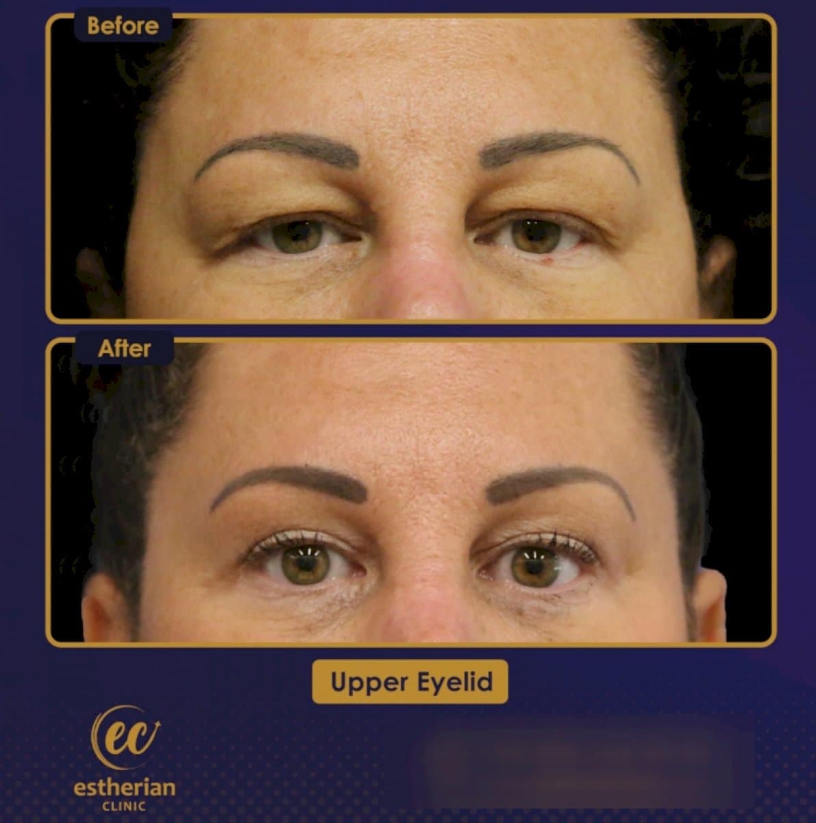 upper eyelid blepharoplasty