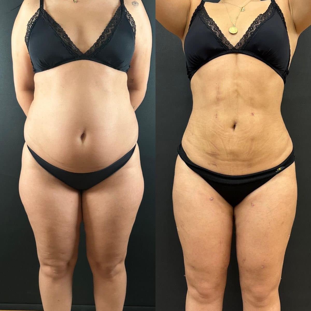 tummy tuck