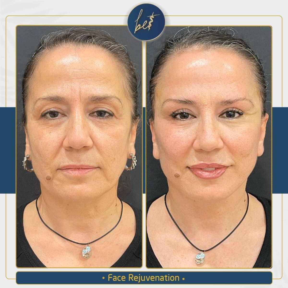 deep plane facelift
