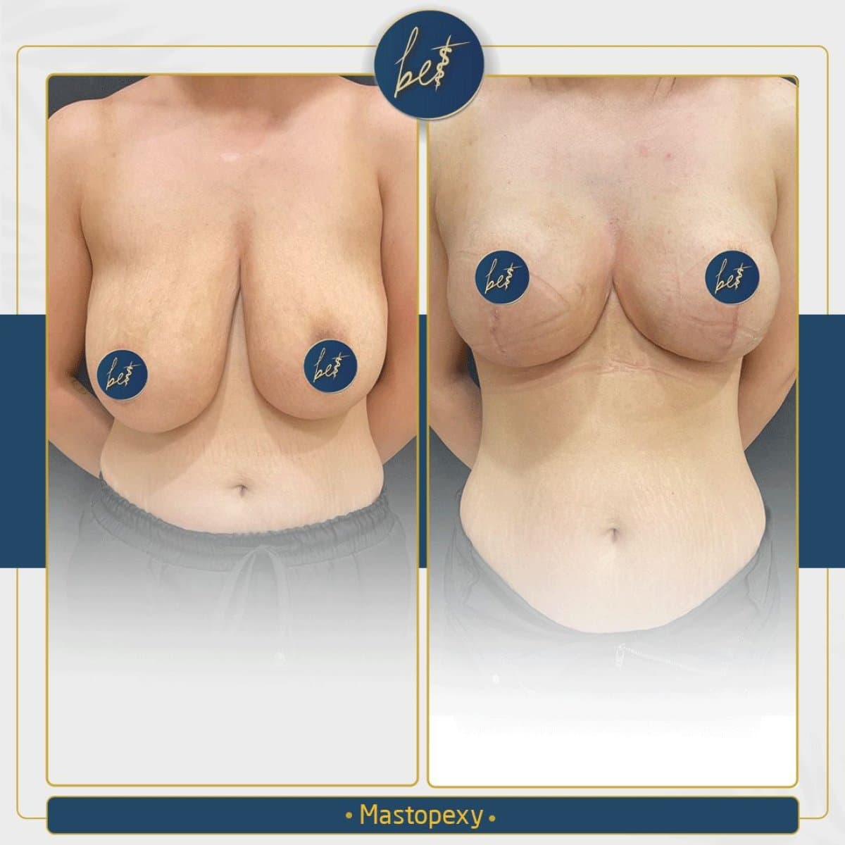 mastopexy