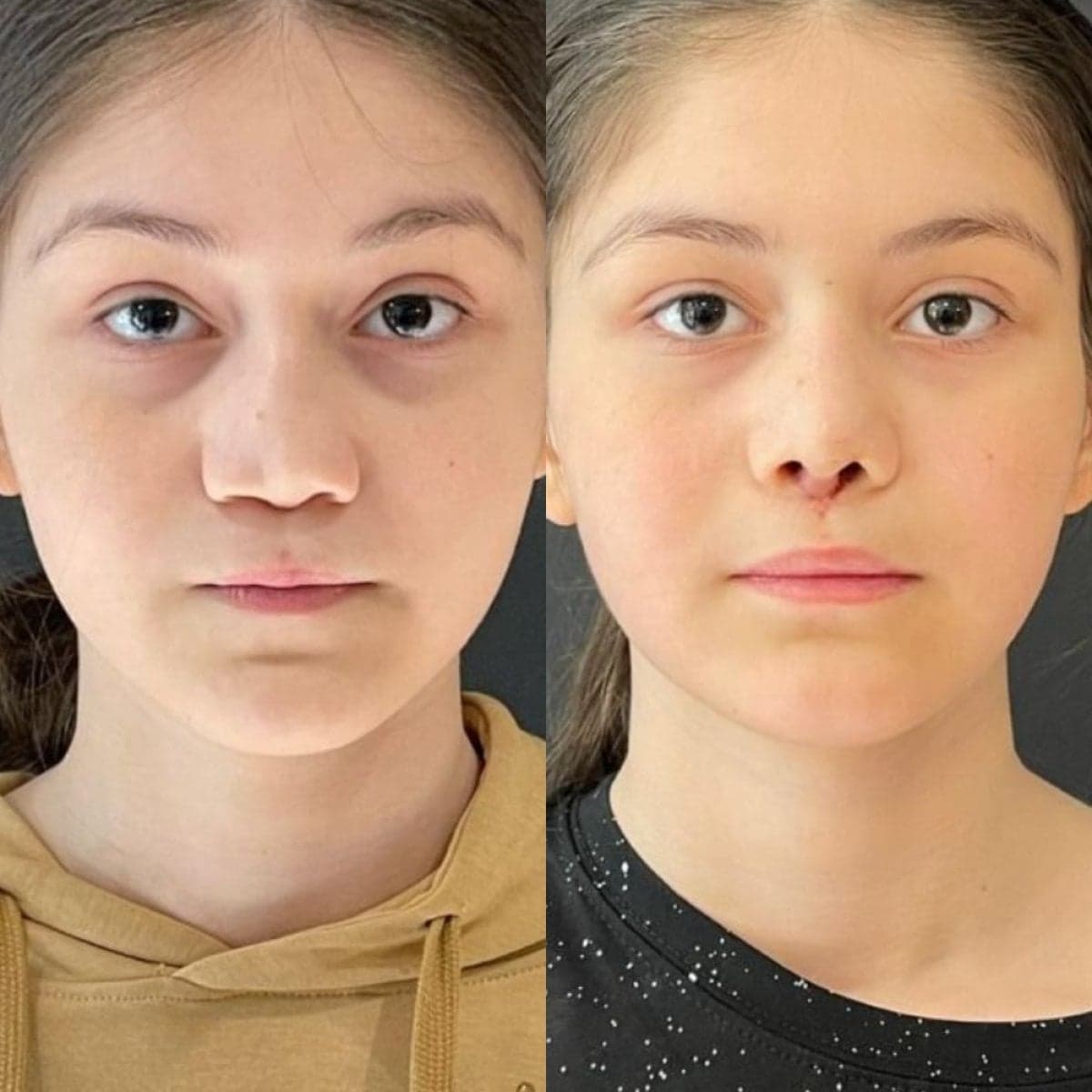 rhinoplasty