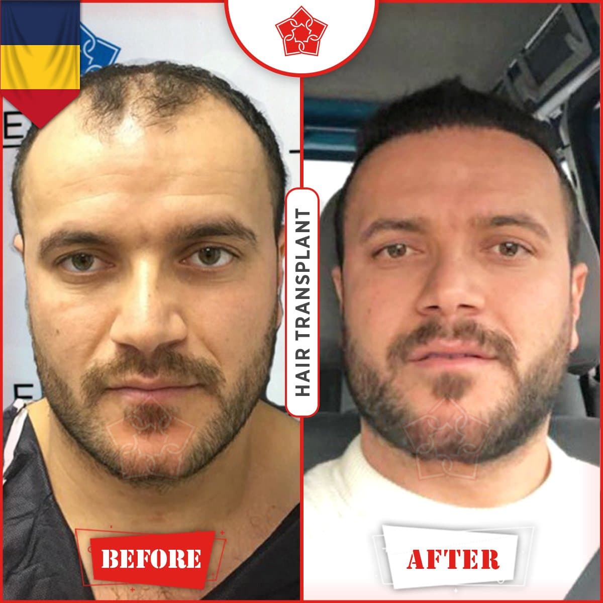 hair transplant