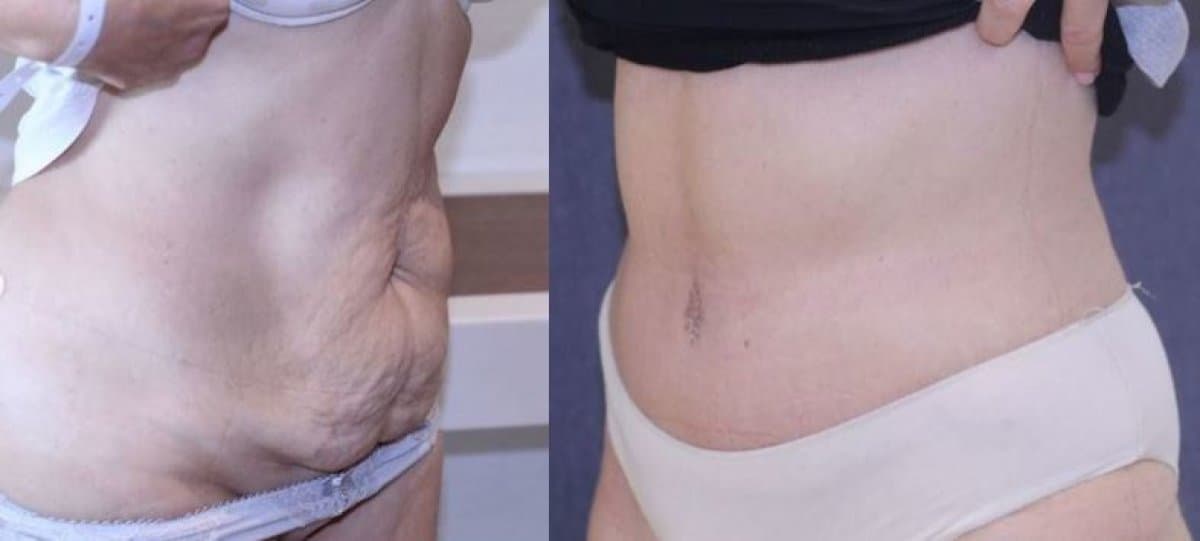 tummy tuck