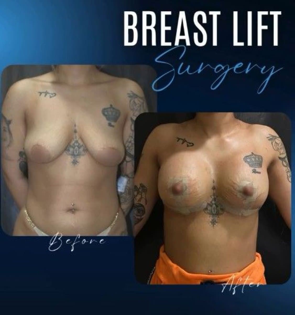 breast lift surgery