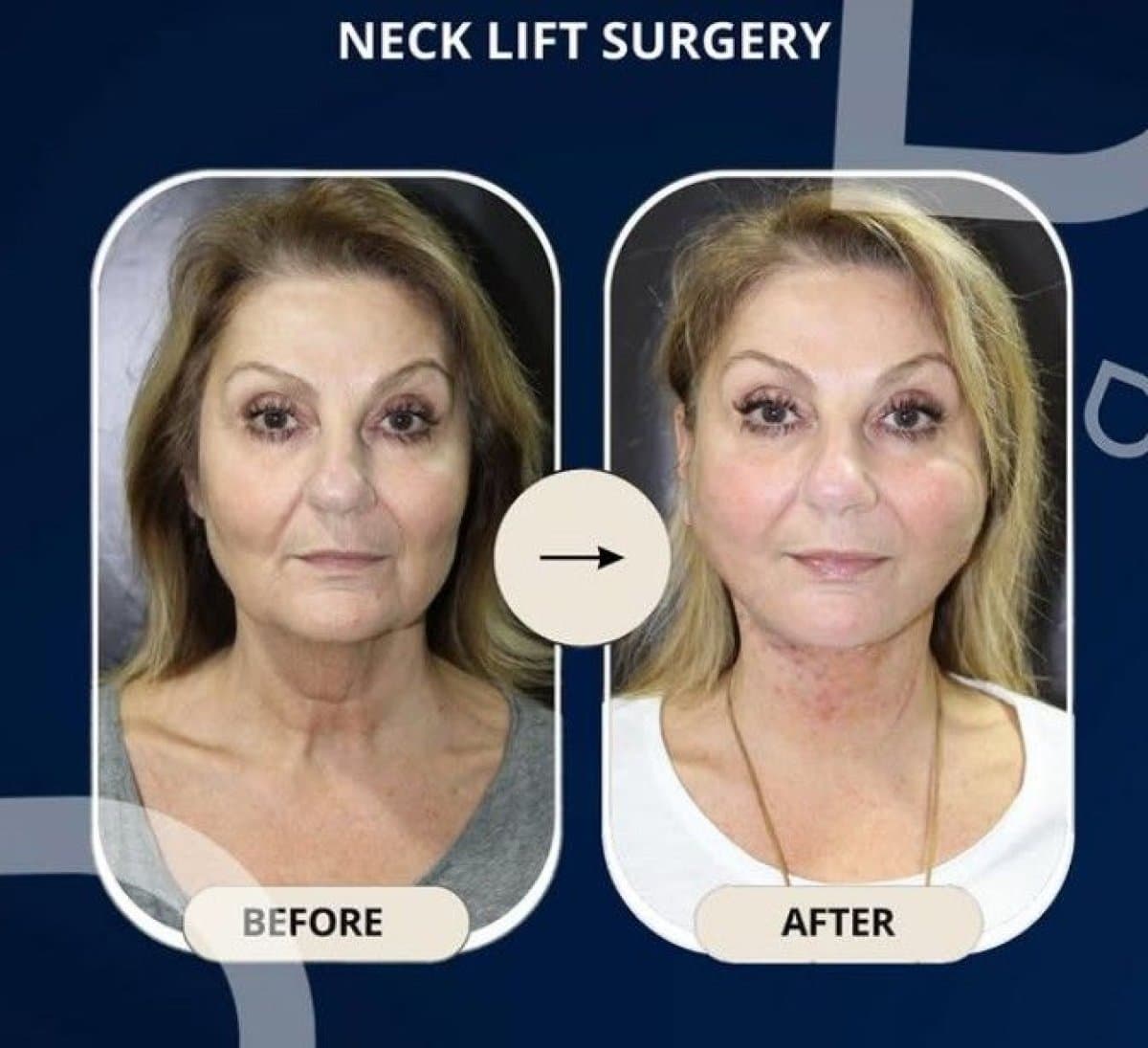 neck lift surgery