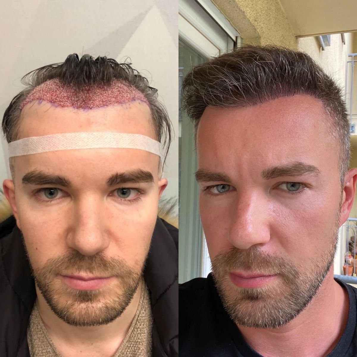 DHI hair transplant