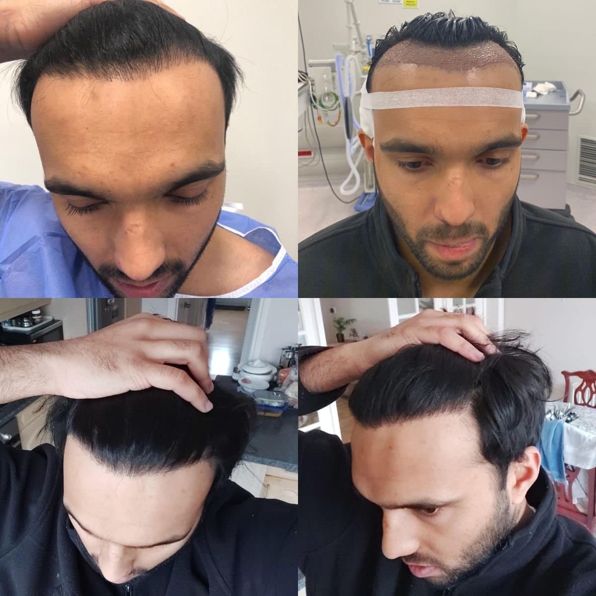 DHI hair transplant