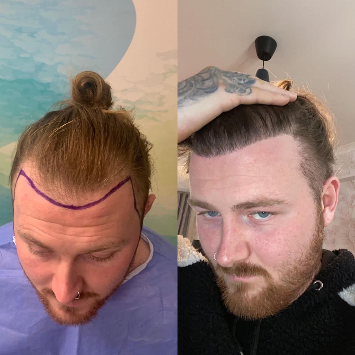 DHI hair transplant