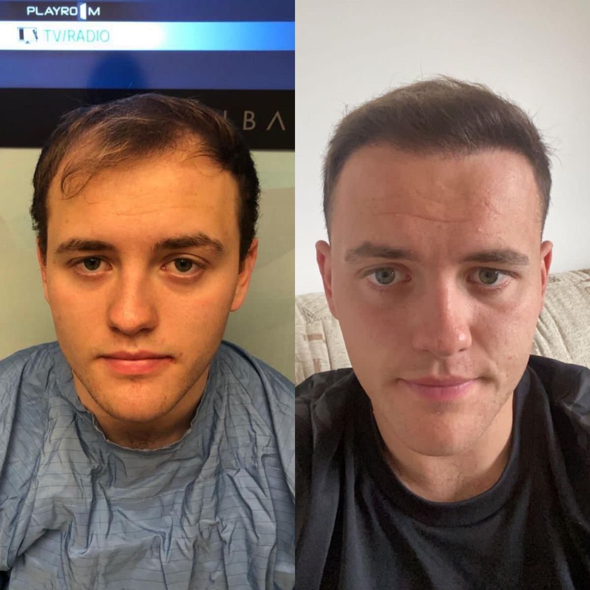 DHI hair transplant