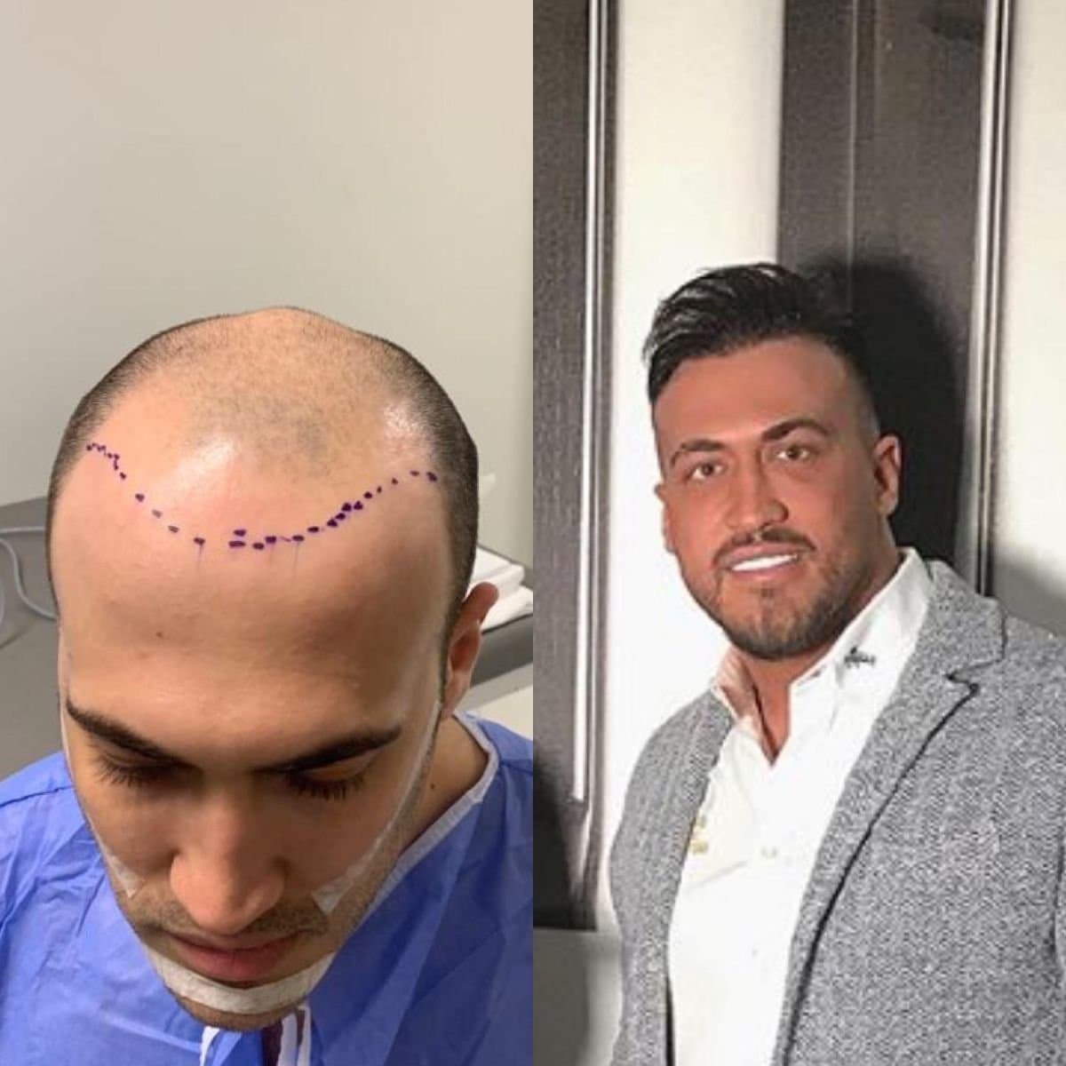 DHI hair transplant