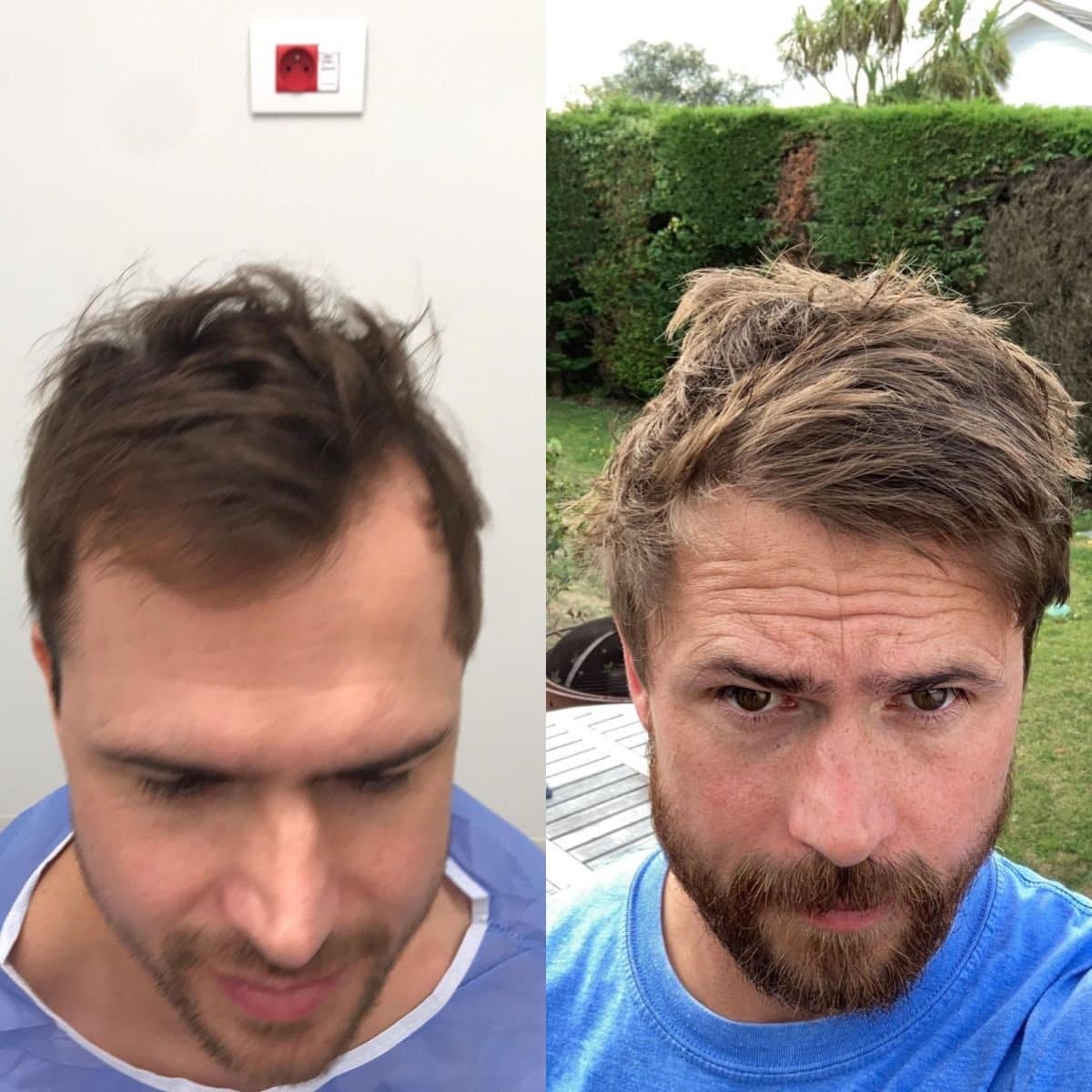 DHI hair transplant